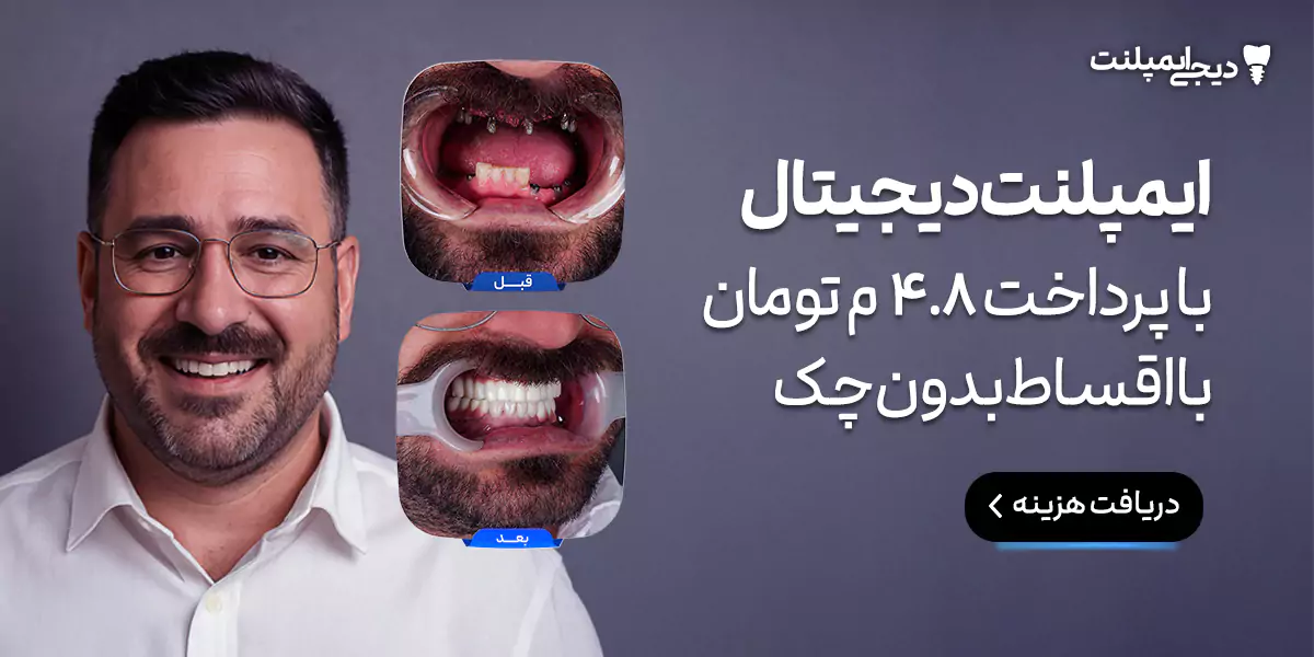 مرجع تخصصی ایمپلنت در ایران