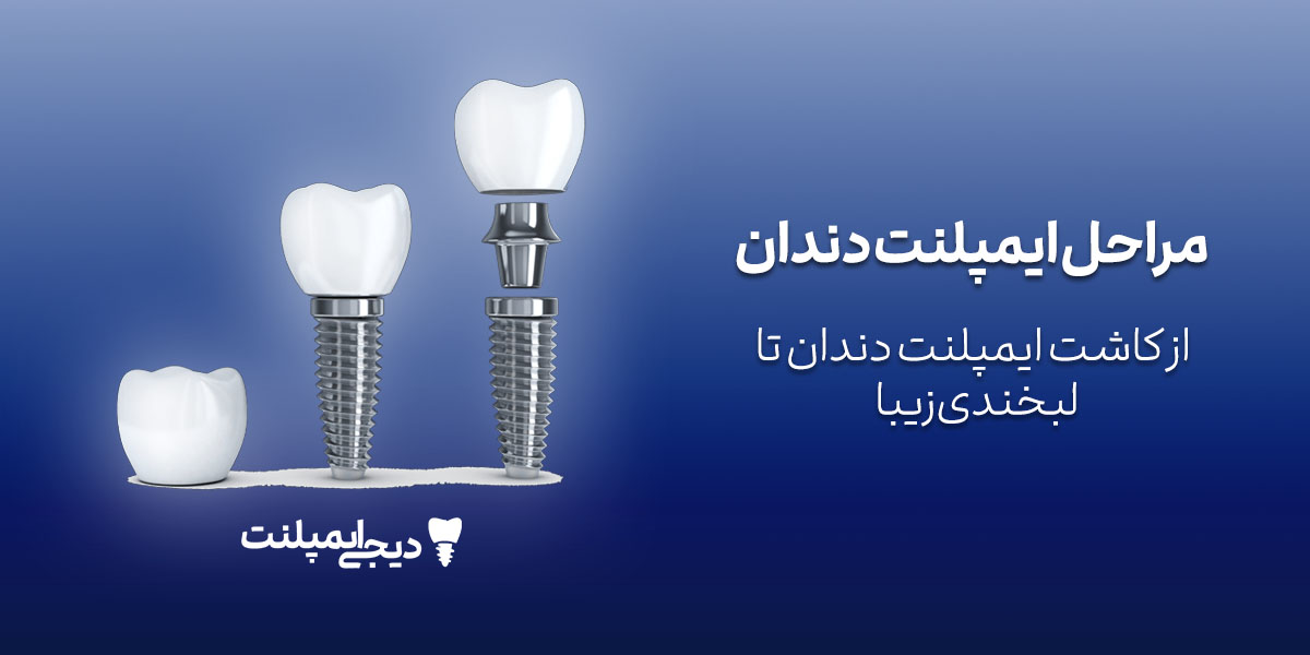 مراحل ایمپلنت دندان: راهنمای کامل و تصویری از جراحی تا روکش