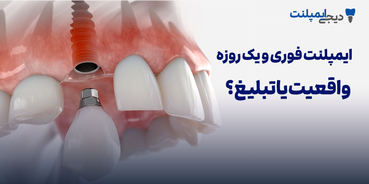 ایمپلنت فوری و یک روزه: واقعیت یا تبلیغ؟ (راهنمای کامل ۱۴۰۴)