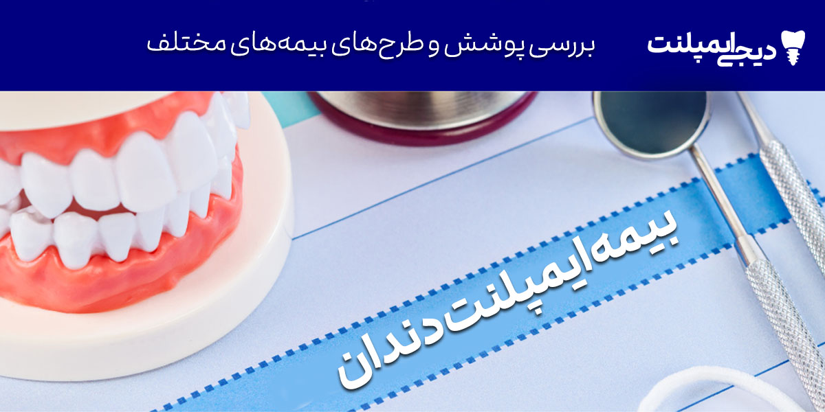 بیمه ایمپلنت دندان: کدام بیمه‌ها و چقدر هزینه را پوشش می‌دهند؟