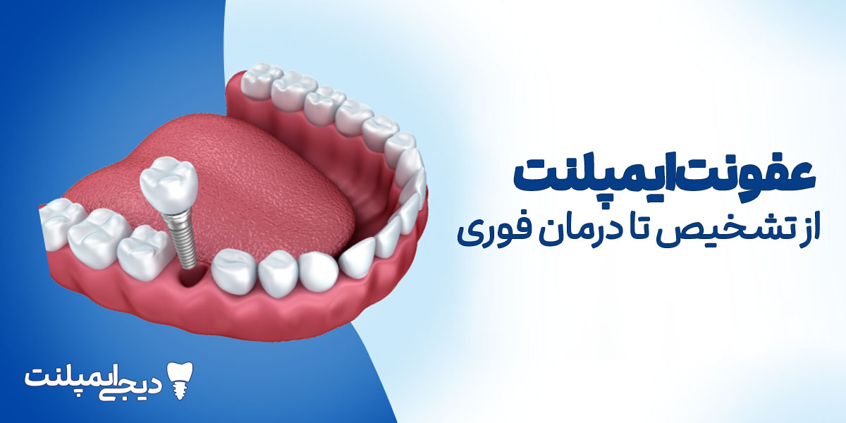 علائم عفونت ایمپلنت چیست؟ (علت، درمان فوری و پیشگیری)