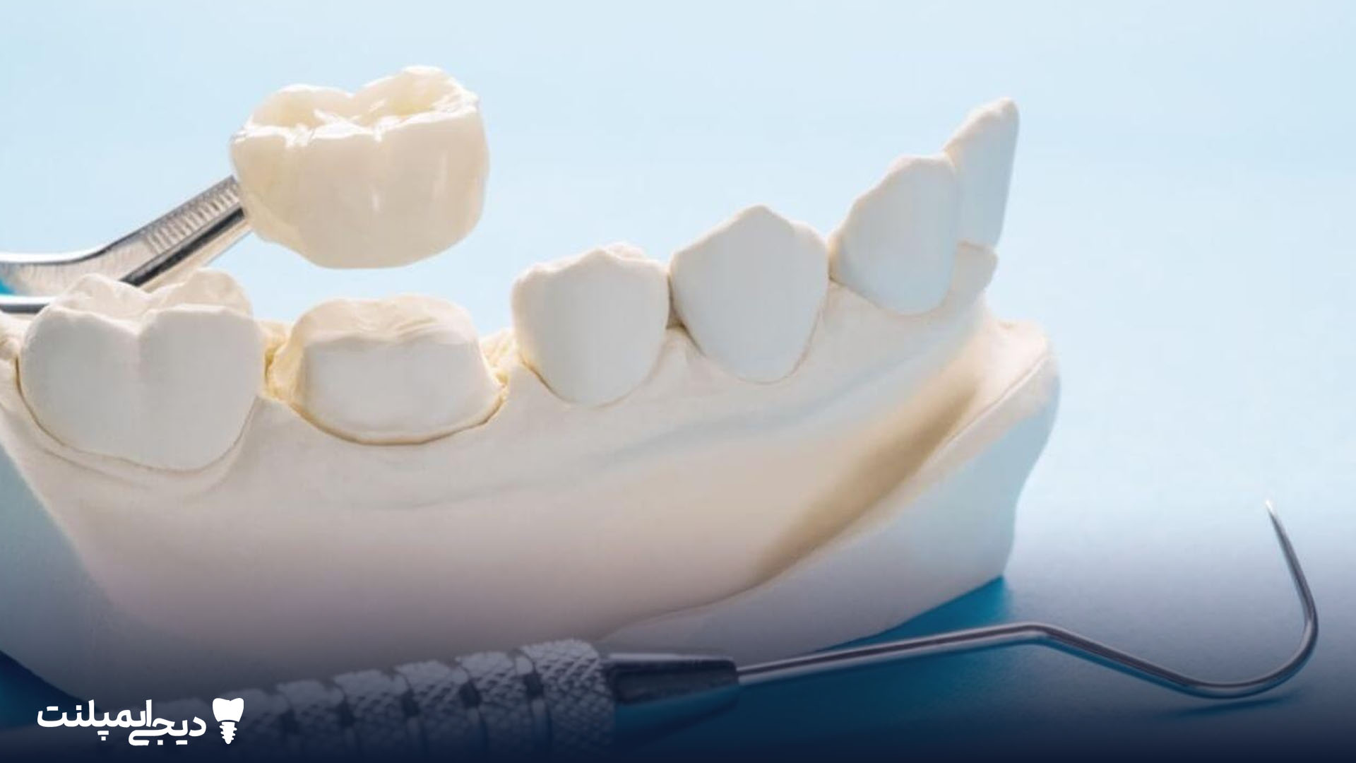 افتادن روکش ایمپلنت