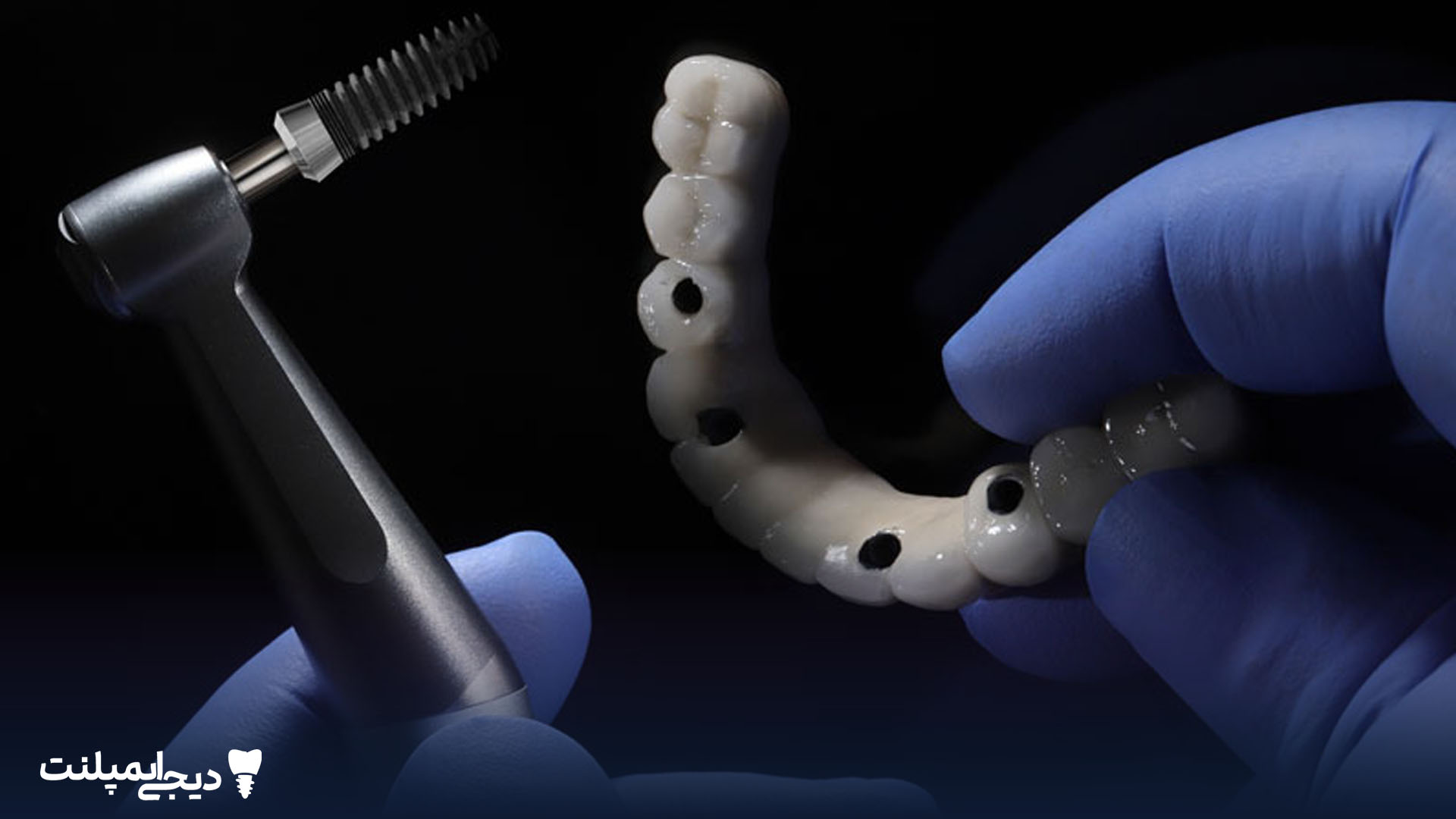 شل شدن پیچ ایمپلنت