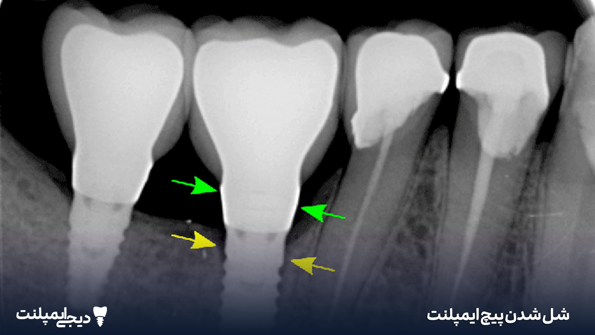 لق شدن اباتمنت