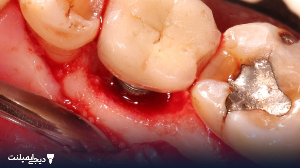 عفونت ایمپلنت