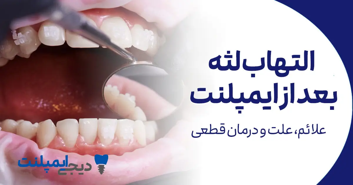 التهاب لثه بعد از ایمپلنت: علائم، علت و درمان قطعی (موکوزیت)