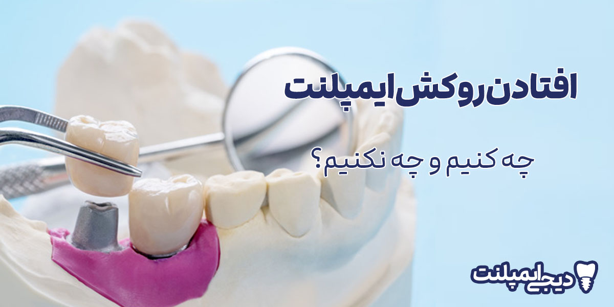 افتادن روکش ایمپلنت: علت چیست و چه کنیم؟ (راهنمای فوری)