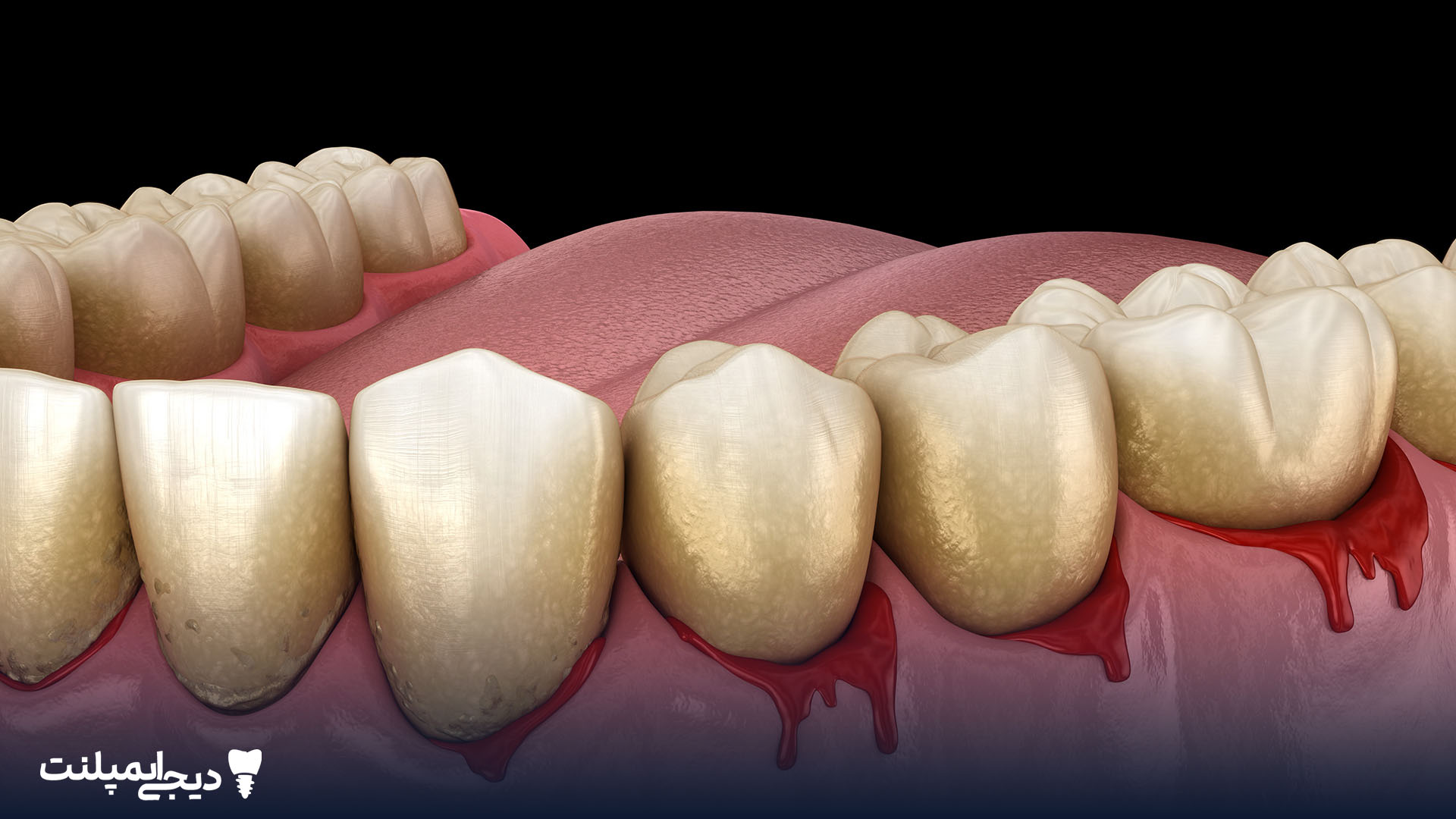 خونریزی لثه عفونت ایمپلنت