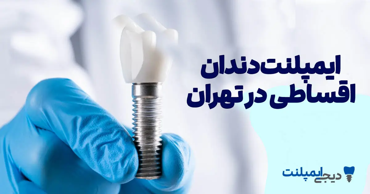 ایمپلنت اقساطی در تهران ۱۴۰۴ (راهنمای کامل + معرفی مراکز)