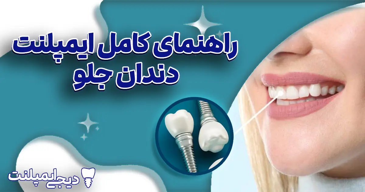 ایمپلنت دندان جلو: راهنمای کامل برای یک لبخند بی‌نقص