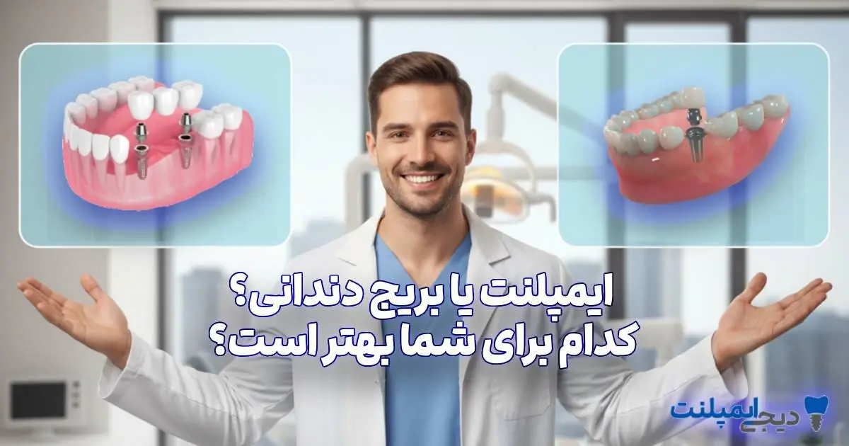 ایمپلنت بهتر است یا بریج دندان؟ مقایسه کامل (کدام را انتخاب کنیم؟)
