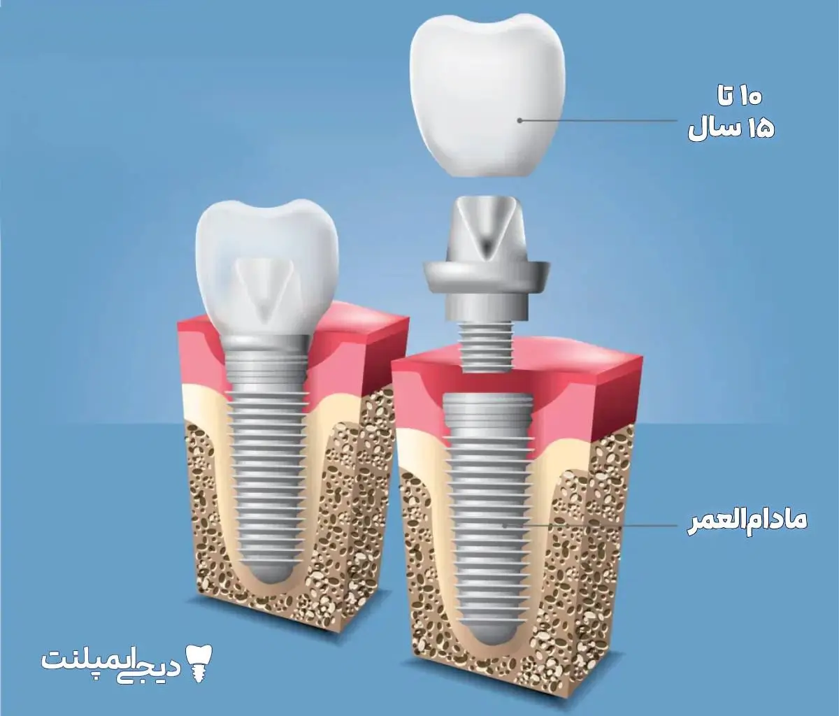 طول عمر ایمپلنت دندان