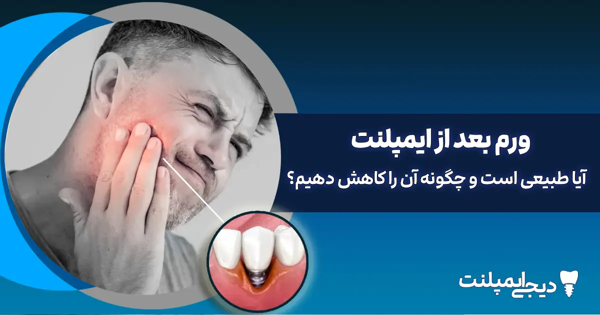 ورم بعد از ایمپلنت: تا چند روز طبیعی است و چگونه آن را کاهش دهیم؟