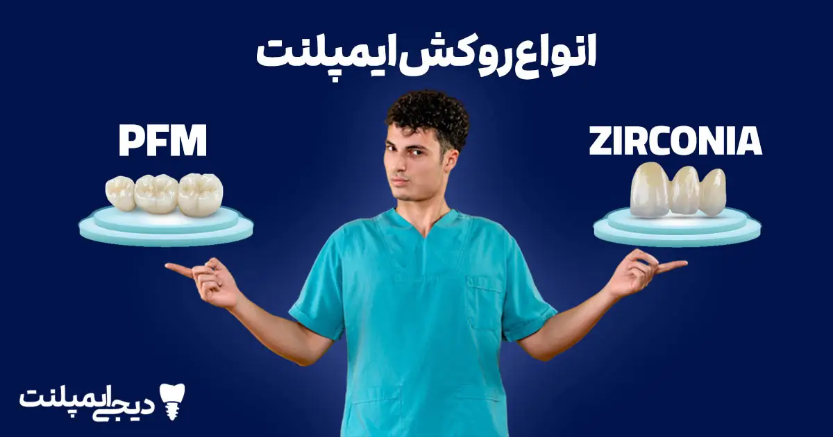 انواع روکش ایمپلنت: مقایسه کامل زیرکونیا و PFM (کدام بهتر است؟)