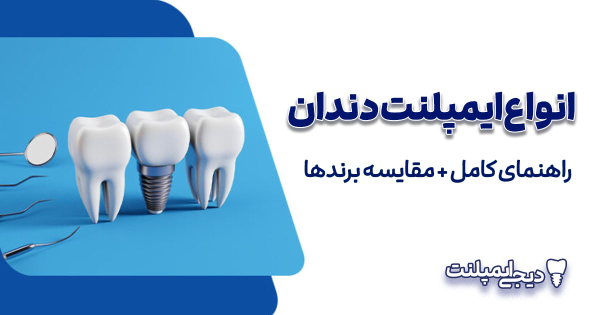 انواع ایمپلنت دندان: راهنمای کامل + مقایسه برندها (کدام برای شما مناسب است؟)