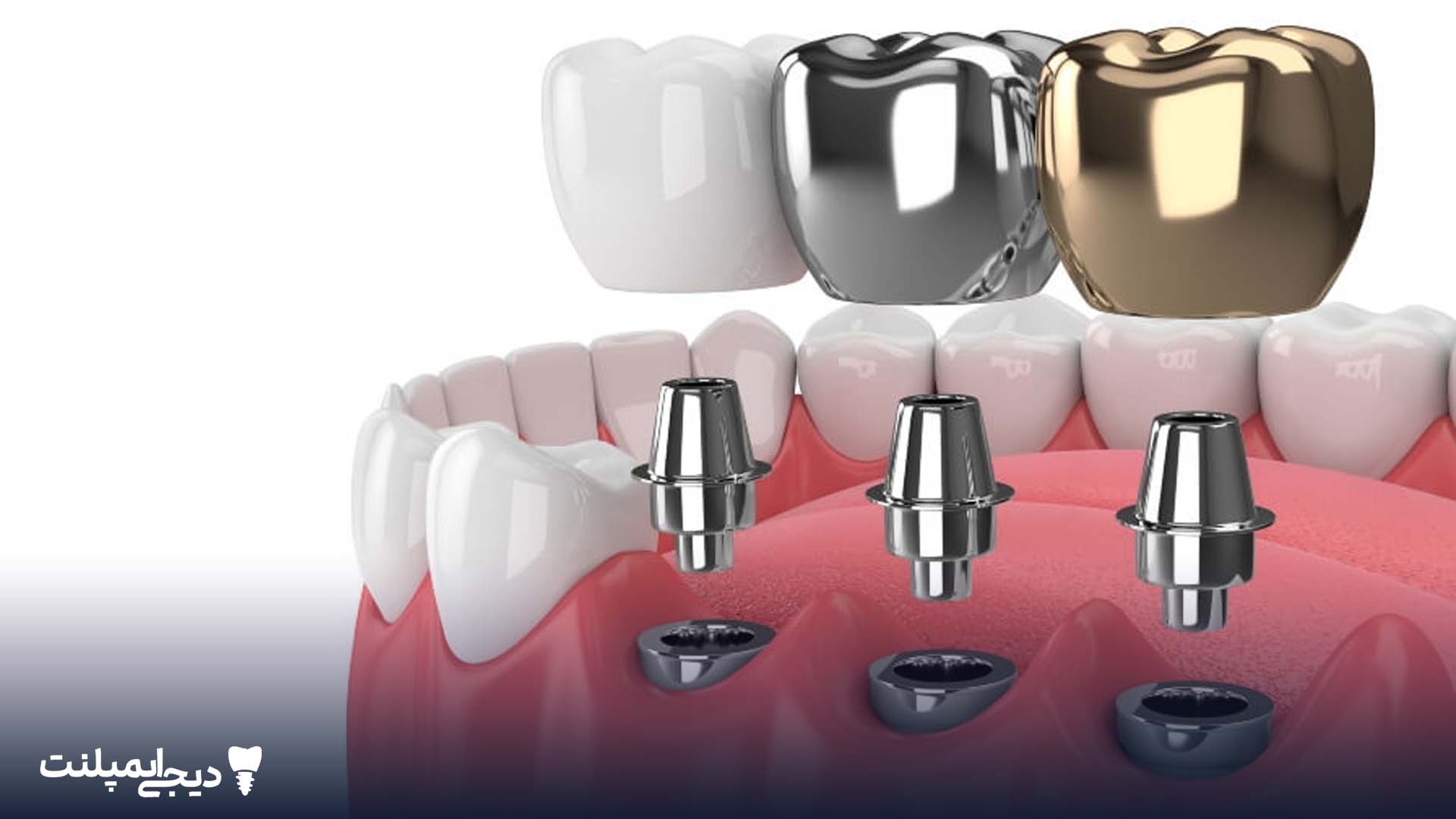 انواع ایمپلنت دندان