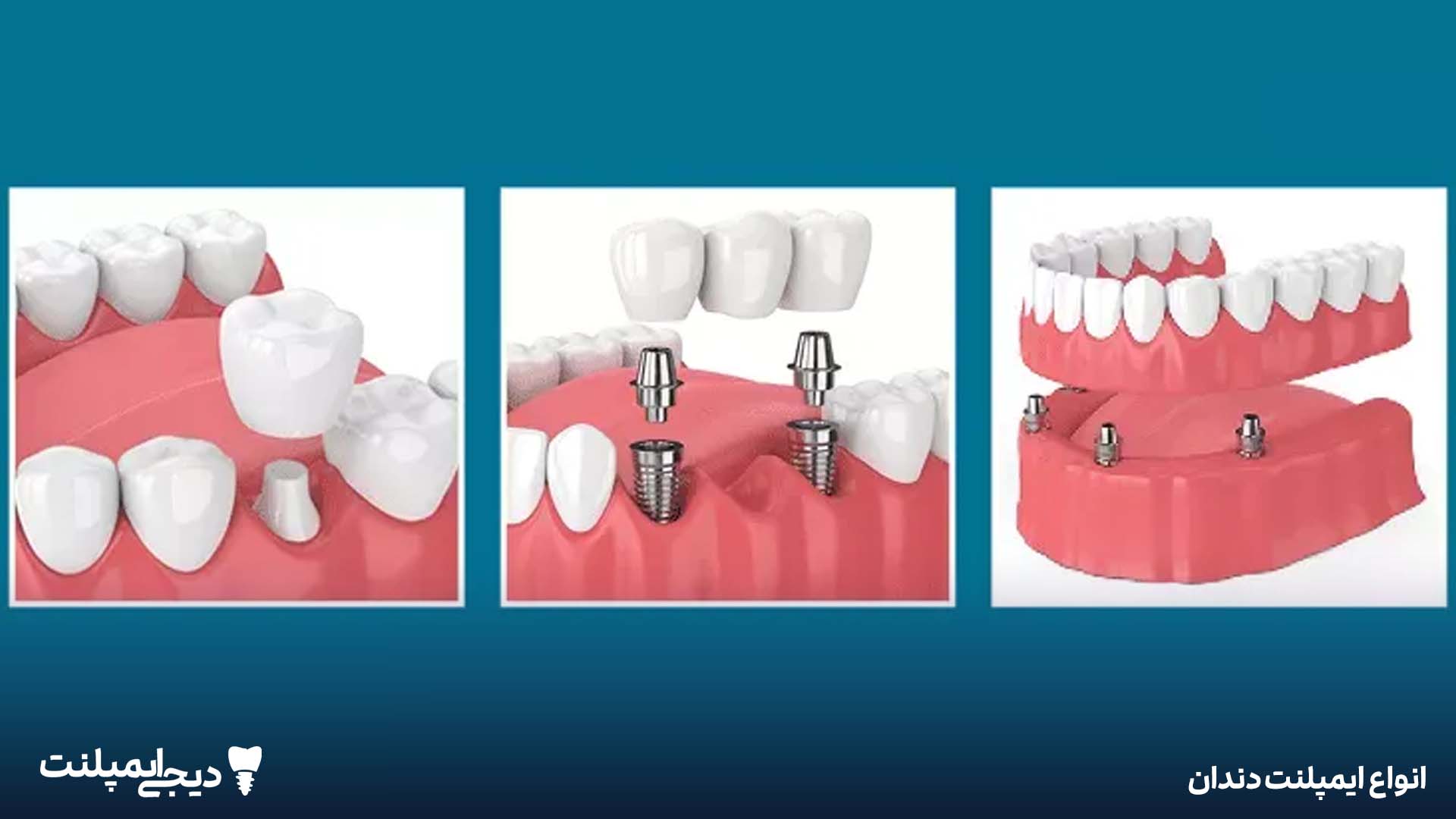 انواع ایمپلنت دندان