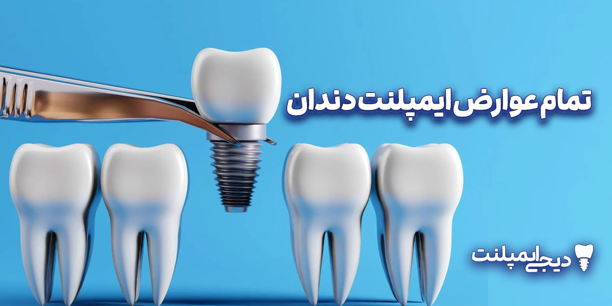 تمام عوارض ایمپلنت دندان: راهنمای کامل مشکلات احتمالی و راه حل آنها