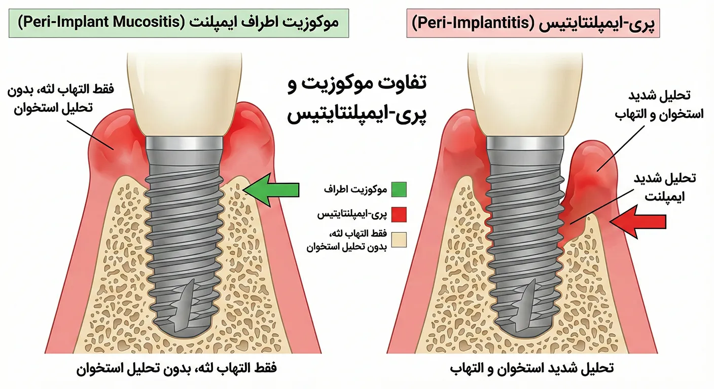 تفاوت موکوزیت و پری ایمپلنتایتیس
