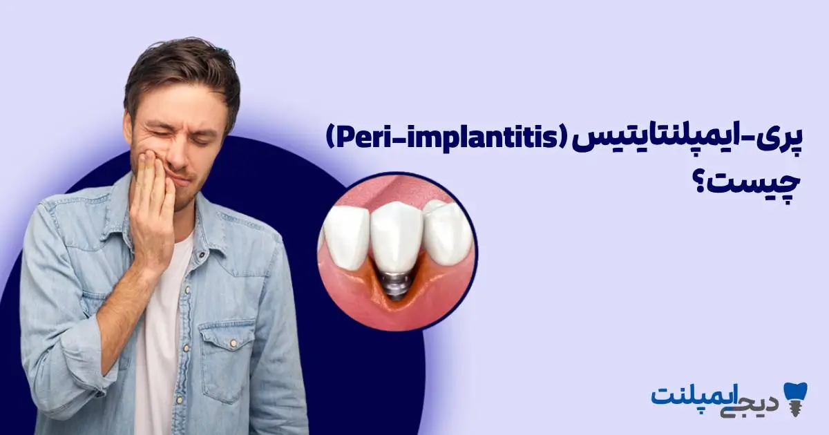 پری-ایمپلنتایتیس چیست؟ (علائم و درمان عفونت لثه دور ایمپلنت)