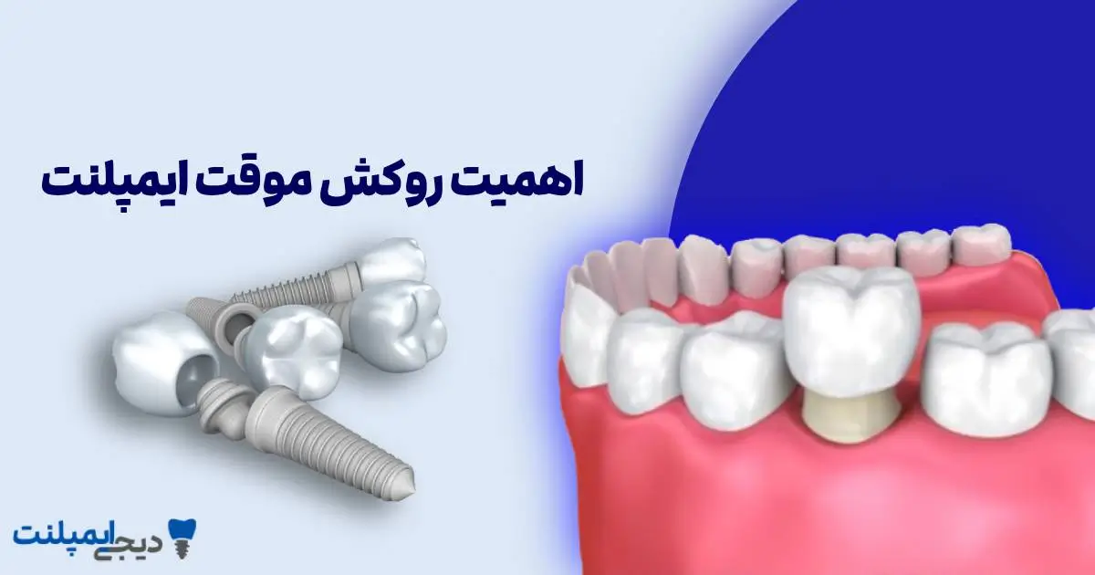 روکش موقت ایمپلنت چیست و چرا اهمیت دارد؟ (راهنمای کامل)