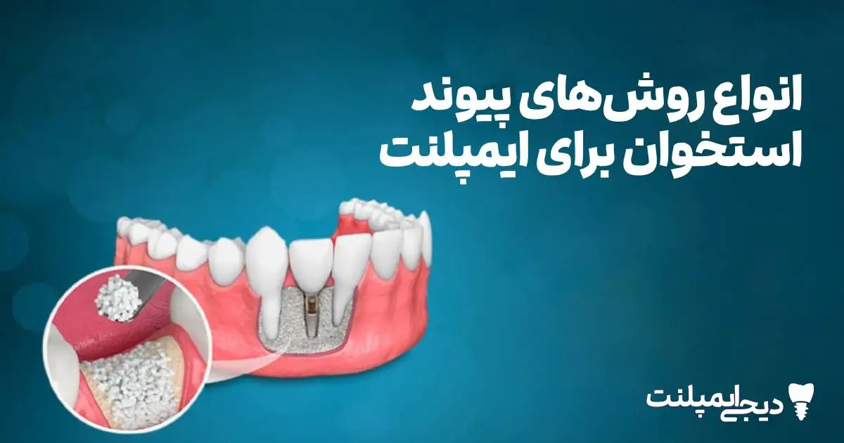 انواع پیوند استخوان ایمپلنت