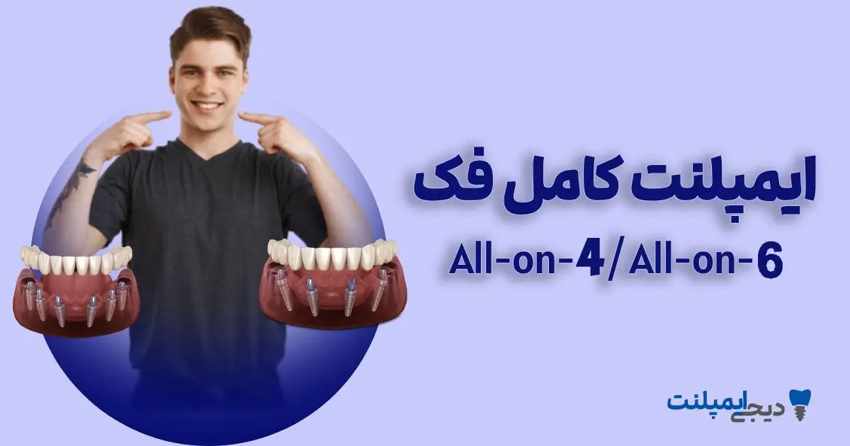 هزینه ایمپلنت کامل فک (All-on-4): قیمت سال ۱۴۰۴ + شرایط اقساطی