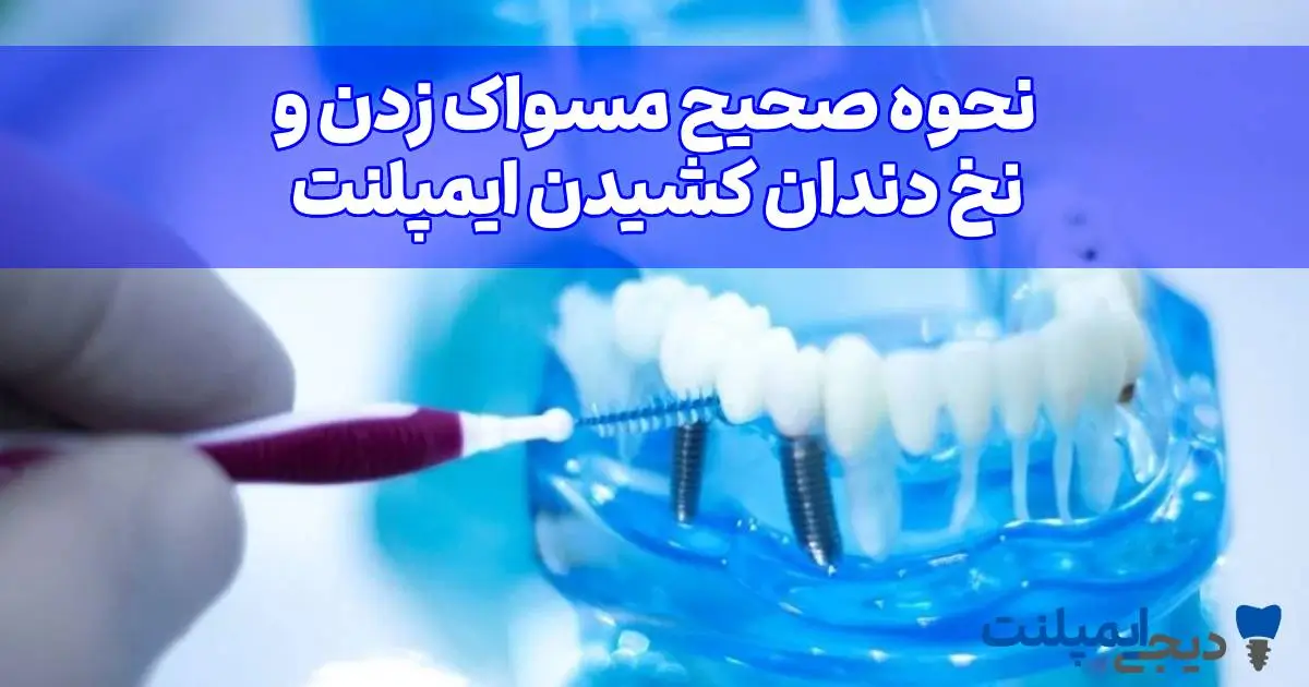 نحوه مسواک زدن ایمپلنت