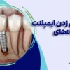 علائم پس زدن ایمپلنت دندان چیست؟ (علل، درمان و پیشگیری)