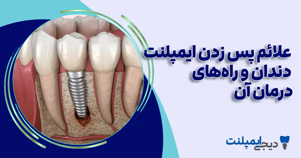 علائم پس زدن ایمپلنت دندان چیست؟ (علل، درمان و پیشگیری)