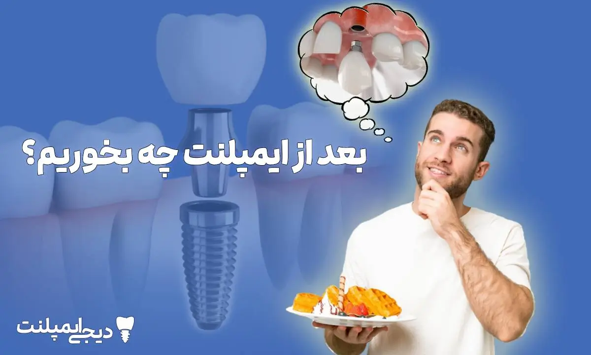 بعد از ایمپلنت چه بخوریم