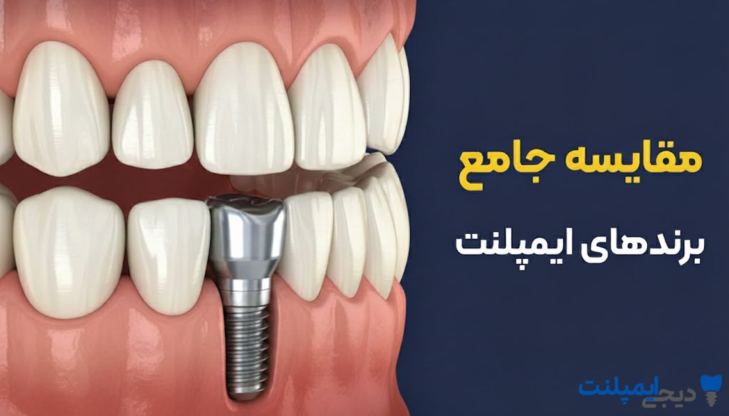 بهترین برند ایمپلنت دندان چیست؟ (مقایسه جامع برندهای سوئیسی، آلمانی و کره‌ای)