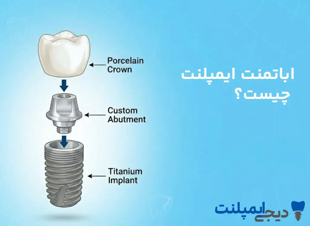 اباتمنت ایمپلنت چیست؟ (انواع و نقش آن در زیبایی نهایی)