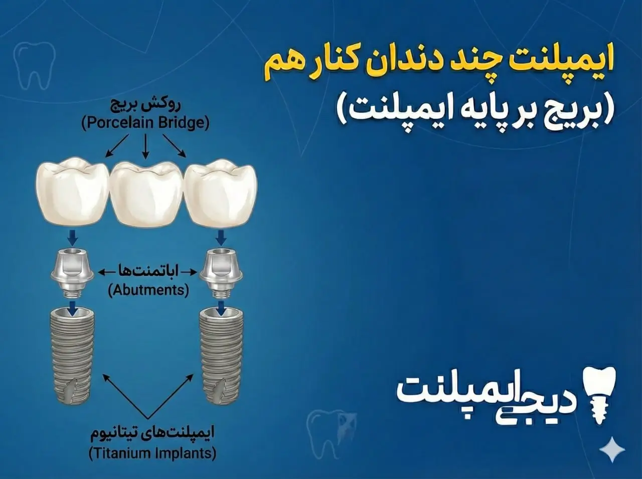 ایمپلنت چند دندان کنار هم (راهنمای کامل بریج بر پایه ایمپلنت)
